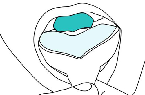 - Speedex light body,  