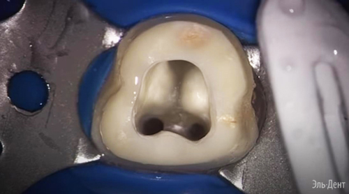  Thermafil Dentsply