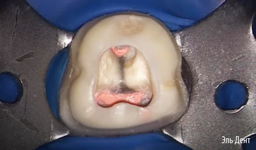  Thermafil Dentsply
