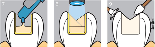    PRIME BOND NT DENTSPLY