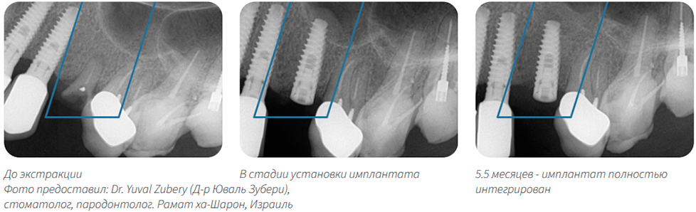 OSSIX BONE  