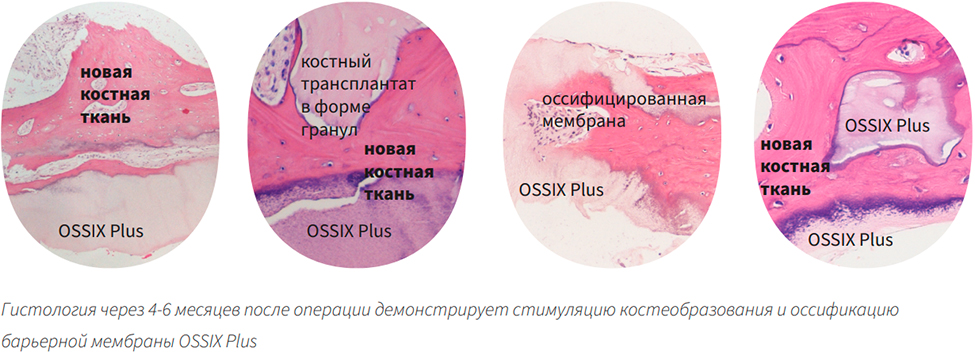 OSSIX Plus  