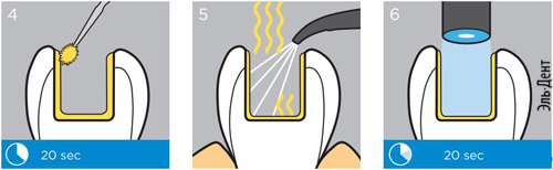   PRIME BOND one ETCH RINSE