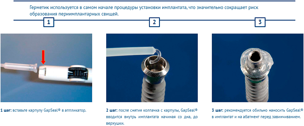 GapSeal