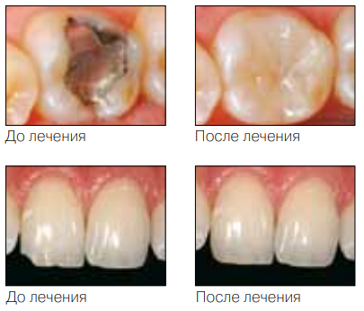 �������� Tetric EvoCeram