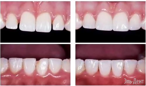 Световой композит Premise Пломбировочный материал Премиз