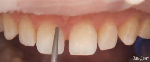 Световой композит Premise Пломбировочный материал Премиз