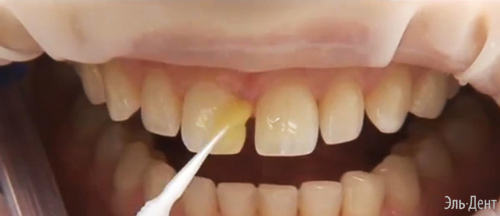 Световой композит Premise Пломбировочный материал Премиз