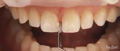 Световой композит Premise Пломбировочный материал Премиз