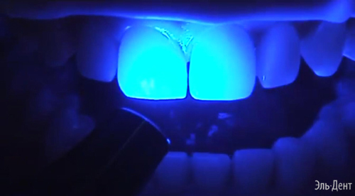 Световой композит Premise Пломбировочный материал Премиз