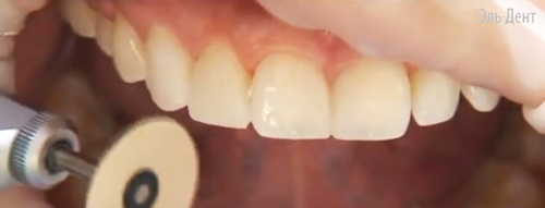 Световой композит Premise Пломбировочный материал Премиз