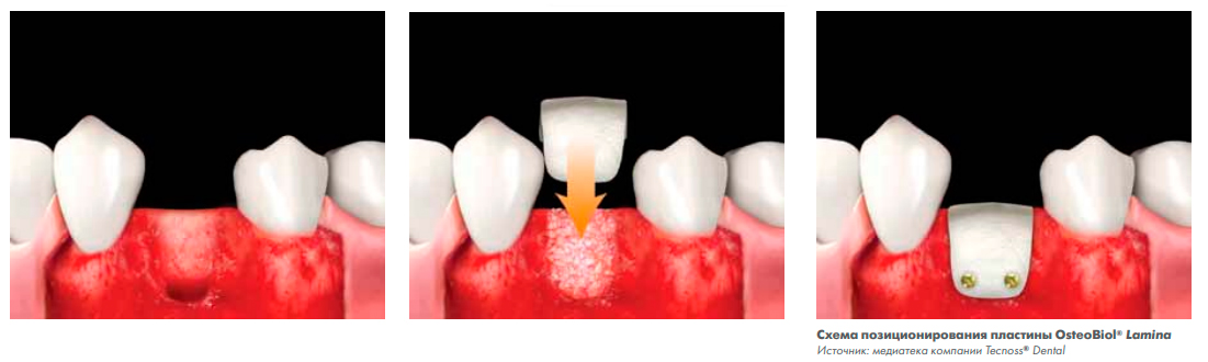 Osteobiol Soft Cortical Lamina ()