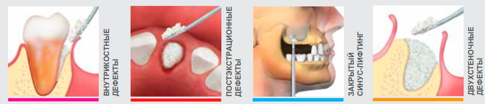 OSTEOBIOL