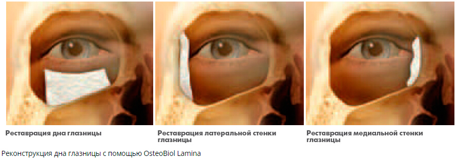   Osteobiol Soft Cortical Lamina