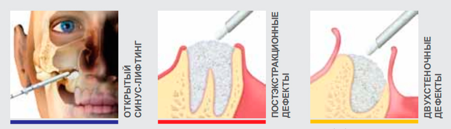 OSTEOBIOL