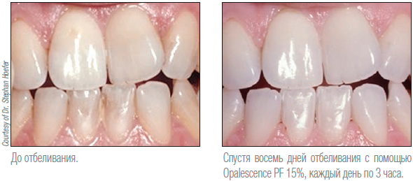 Opalescence PF