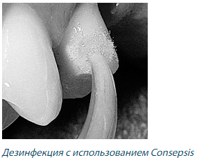 consepsis
