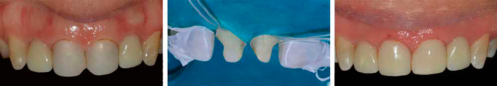 DenFil -   