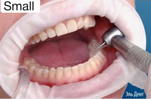 OptraGate  Small �����, 1��.,  Ivoclar