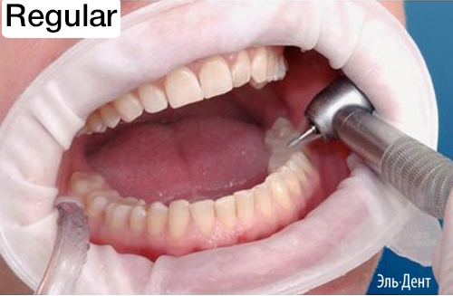 OptraGate  Regular �����������, 1��.,  Ivoclar.